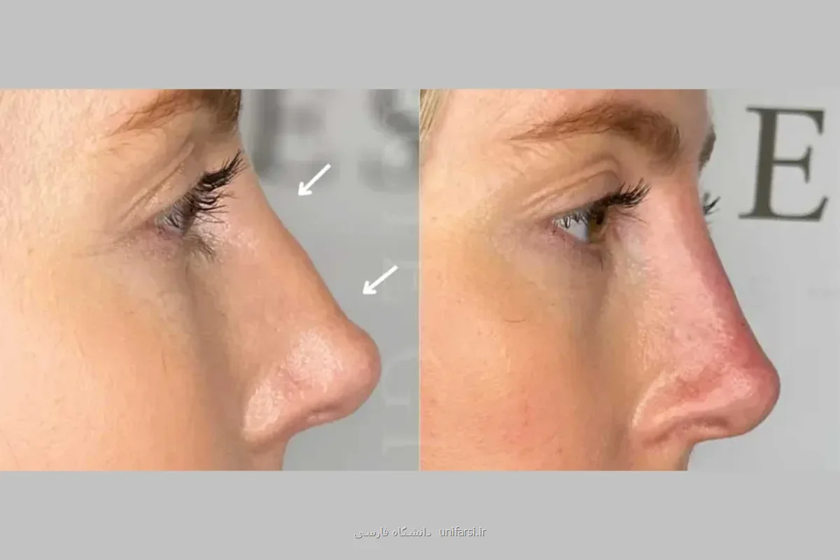مزایا و معایب فیلر بینی